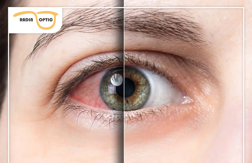 چالش های اصلاح دید در بیماران با خشکی شدید چشم 