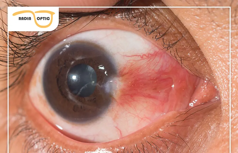 ناخنک چشم؛ علائم، علت‌ها و روش‌های درمان