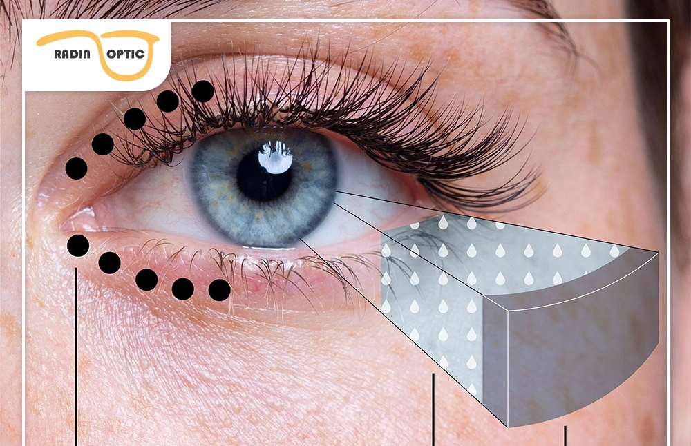 لنز شارژی (ارتوکراتولوژی) | درمان نزدیک&zwnj;بینی بدون جراحی + قیمت