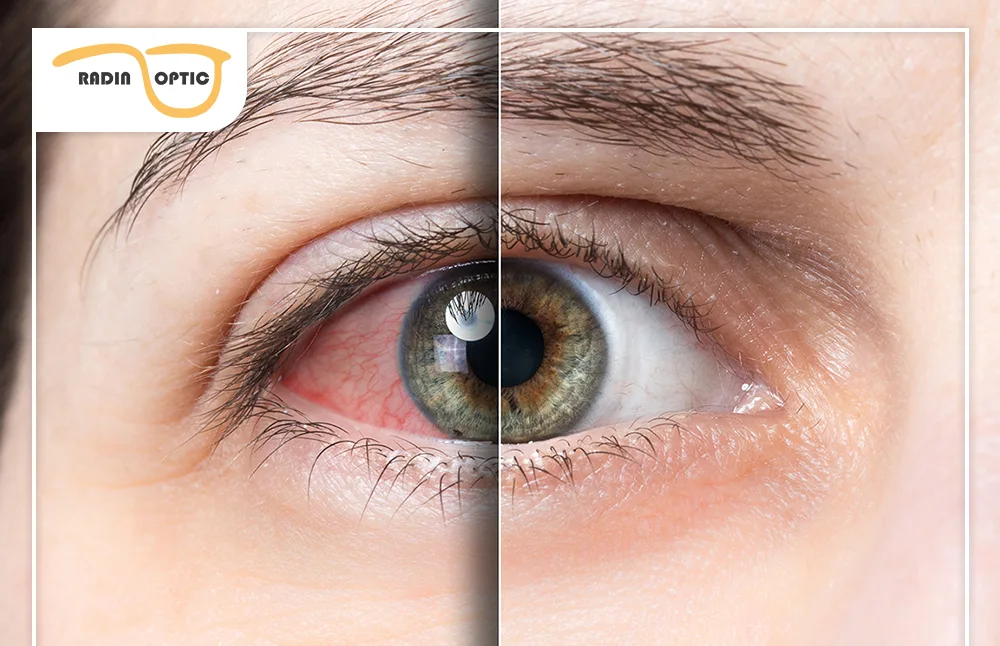 علت به وجود آمدن خشکی چشم شدید