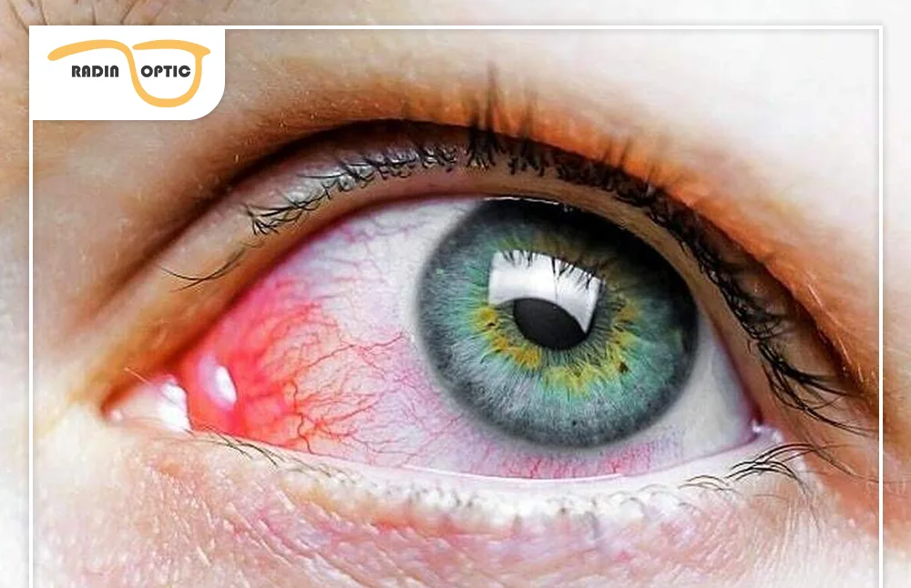 بیماری&zwnj;های شبکیه | علل، علائم و راه&zwnj;های درمان