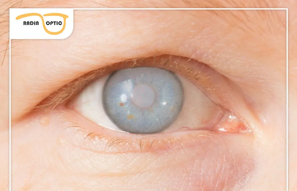 از کجا بفهمیم دچار آب مروارید شده‌ایم؟ نشانه‌ها و راهنمای تشخیص